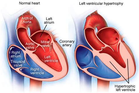 left ventricle not pumping properly.